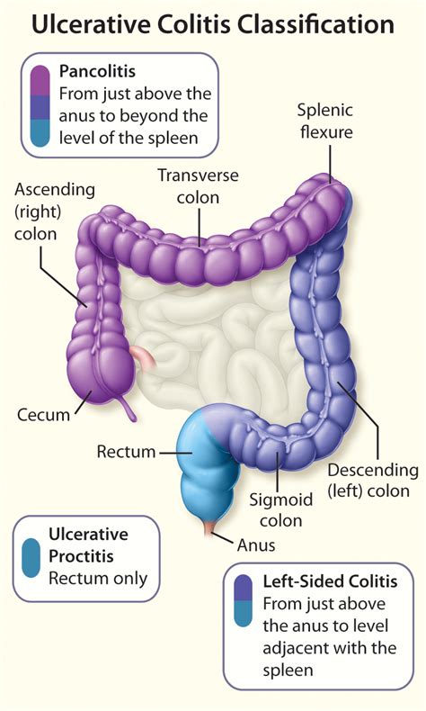 The Patient with Newly Diagnosed Ulcerative Colitis | HealthPlexus.net