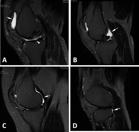 Association between MRI-detected knee joint regional effusion-synovitis and structural changes ...