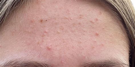 is my skin dehydrated?😕 [acne] : r/SkincareAddiction