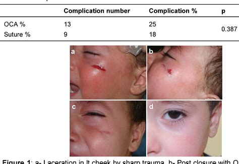 Figure 1 from Prospective comparison of primary wound closure with tissue- adhesive versus ...