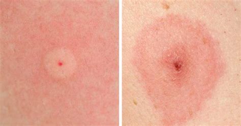 How To Identify 10 Of The Most Common Bug Bites | Grandma's Things