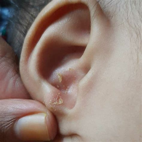 #viralinfection swelling near ear, no fever and other symptoms. is that something to worry about ...