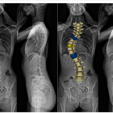 EOS 3D reconstruction. EOS scan and 3D reconstruction of a 16-year-old ...