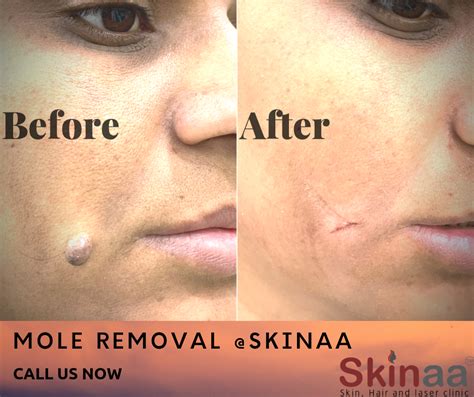 Get Rid of Unsightly Moles