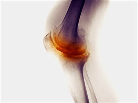 Cryoneurolysis Shows Promise in Treating Knee Arthritis