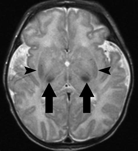 Hypoxic-Ischemic Brain Injury: Imaging Findings from Birth to Adulthood ...