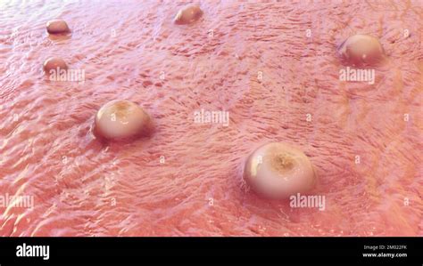 Skin lesions in monkeypox infection, illustration Stock Photo - Alamy