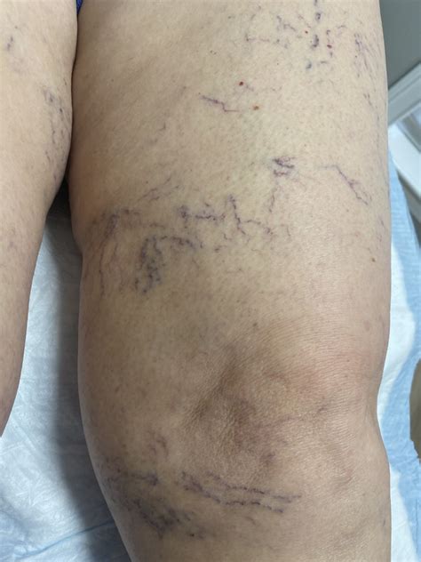 Spider Veins | Fayette Surgical Associates