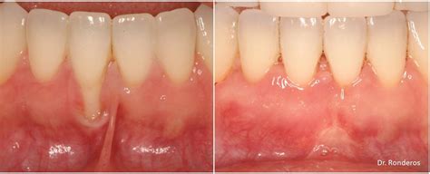 Gingival Graft