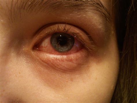 File:An eye with conjunctivitis.jpg