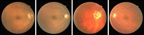 Optic disc images for evaluating the proposed algorithm [19] | Download ...