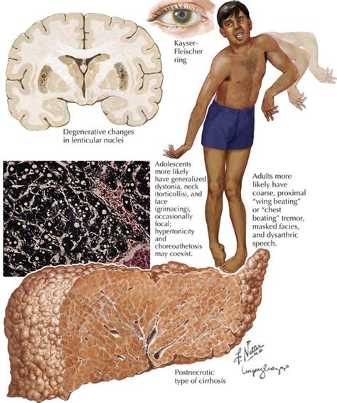 Wilson Disease | Neupsy Key