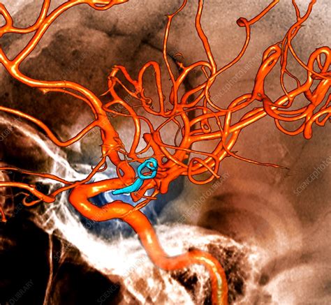 Brain Aneurysm Shown Explained Using A 3d Medical Ani - vrogue.co