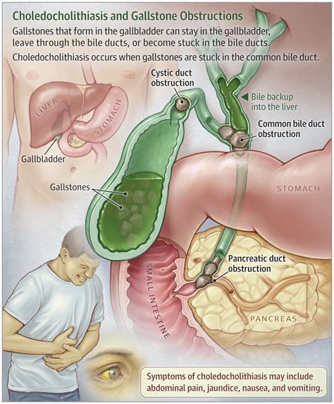 Choledocholithiasis | Medical knowledge, Medical education, Medical surgical nursing