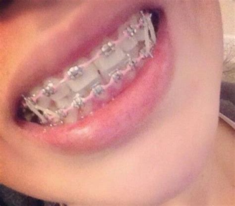 Braces | Braces colors, Brace face, Cute braces