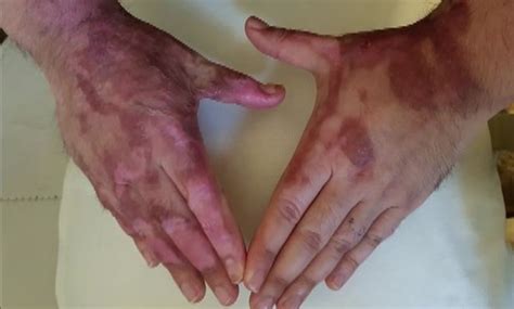 'I've got to live with this forever': Dad's horrific burns show why you should never tackle a ...