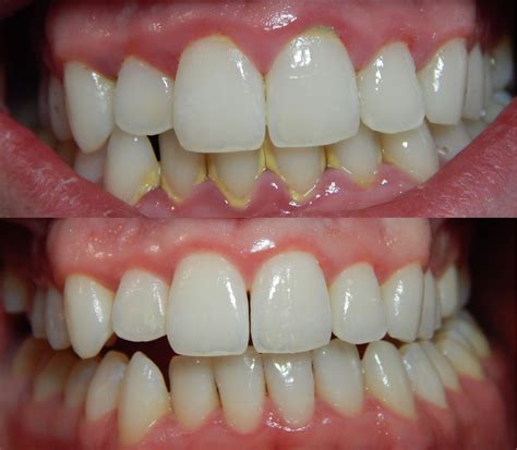 How to get rid of tartar at home without going to the dentist - TheBeautyMania.net | Gum health ...