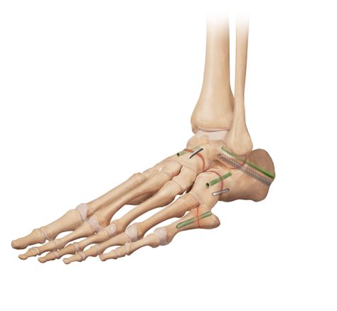 Arthrex - Triple Arthrodesis