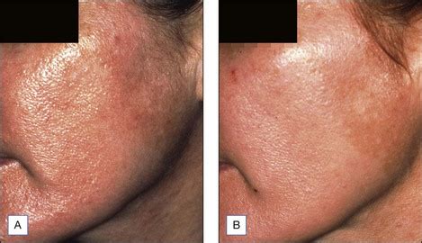 Salicylic Acid Peels | Clinical Gate