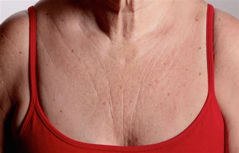 Calcium hydroxylapatite helps improve chest wrinkles in women: Study