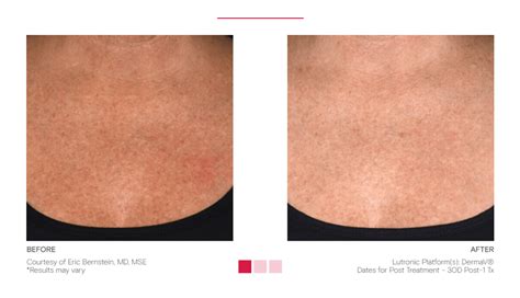 Derma V Pigmentation Treatment in SoHo | Weiser Skin MD