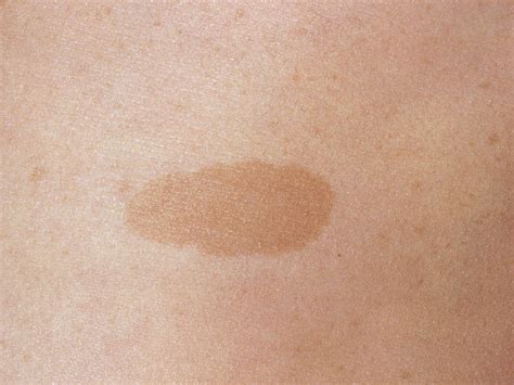 Brown Birthmarks