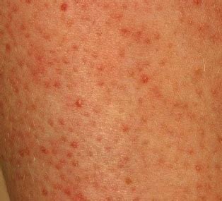 Pinprick Red Dots On Skin Not Itchy Pictures / What Are These Tiny Red Spots On My Skin? Causes ...