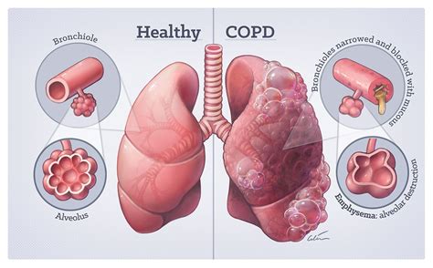 Healthy vs COPD lungs | Medical illustration, Copd, Nursing notes