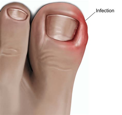 Surgery for ingrowing toenail (adult) | healthdirect