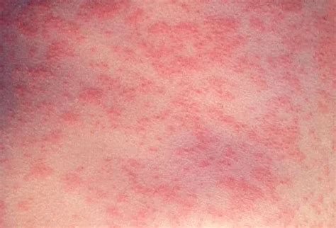 Measles Rash Remedy - werohmedia