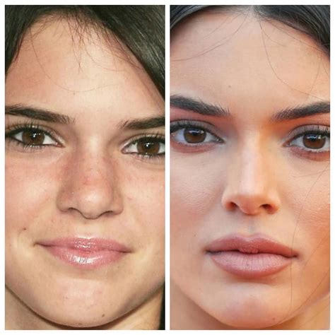 Kendall Jenner Plastic Surgery - A Complete History | WHO Magazine | Kendall jenner plastic ...