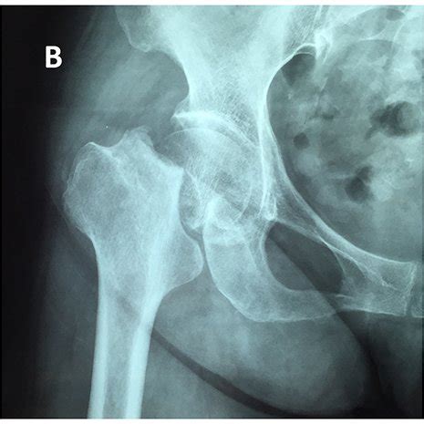 Chest X-ray images of a 72-year old male patient with femoral neck... | Download Scientific Diagram