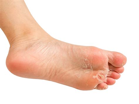 How to Get Rid of Athlete’s Feet? Expert Advice on Cures & Tips ...