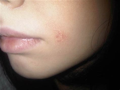 Psoriasis on face pictures | Symptoms and pictures