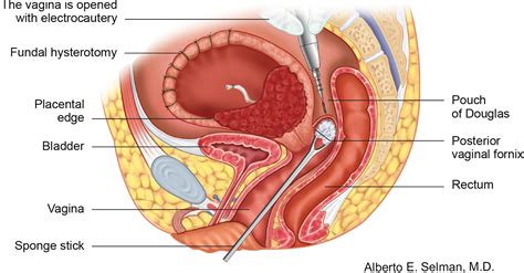 Caesarean hysterectomy for placenta praevia/accreta using an approach ...