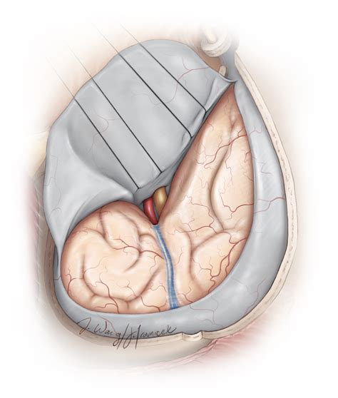 Dural Opening and Closure | The Neurosurgical Atlas