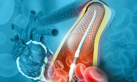 Drug-coated balloon angioplasty effective in dialysis related blockage ...