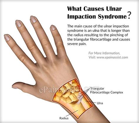 Pin on Impaction