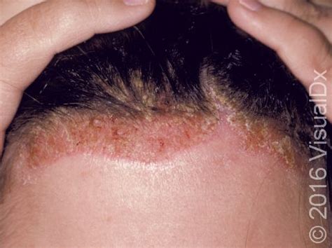 Seborrheic Dermatitis Scalp