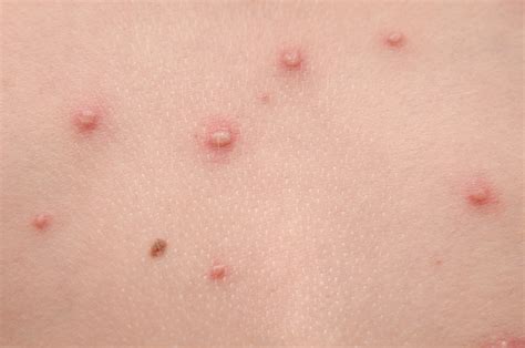 pics of chickenpox - pictures, photos