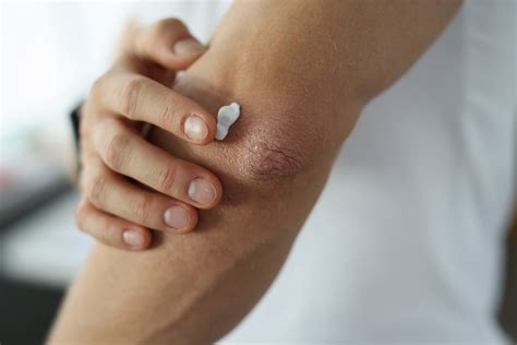 Psoriasis 101: Overview, Symptoms, Causes & Treatment - Homage