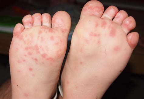 Hand foot and mouth cases reported in Kent schools