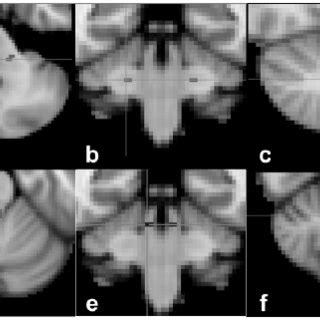 Example of the tractography reconstruction of the middle cerebellar ...