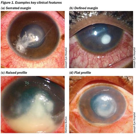 Microbial Keratitis