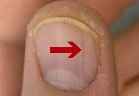 How To Get Rid Of A Splinter Hemorrhage - HOWTOREMVO