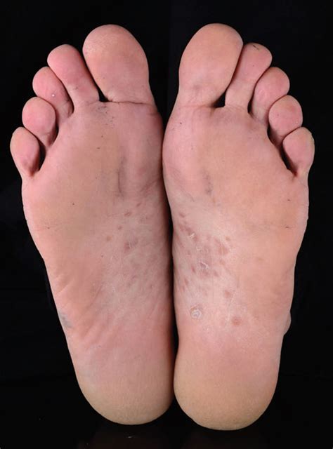 Syphilis on the rise again – look at the feet!