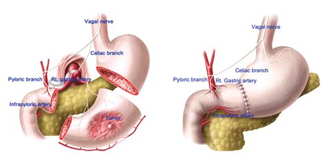 Surgical procedure of pylorus-preserving gastrectomy (PPG) 11)... | Download Scientific Diagram