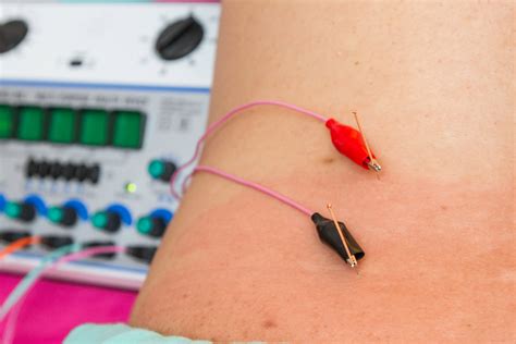 Hygeia's Electrical Stimulation of the Acupuncture Needles Treatment ...