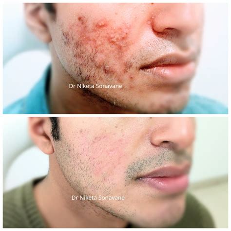 Acne Treatment In Mumbai - Cost, Before After, Laser, Acne Specialist