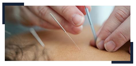 Dry Needling Physical Therapy and Its Benefits | OneRehab